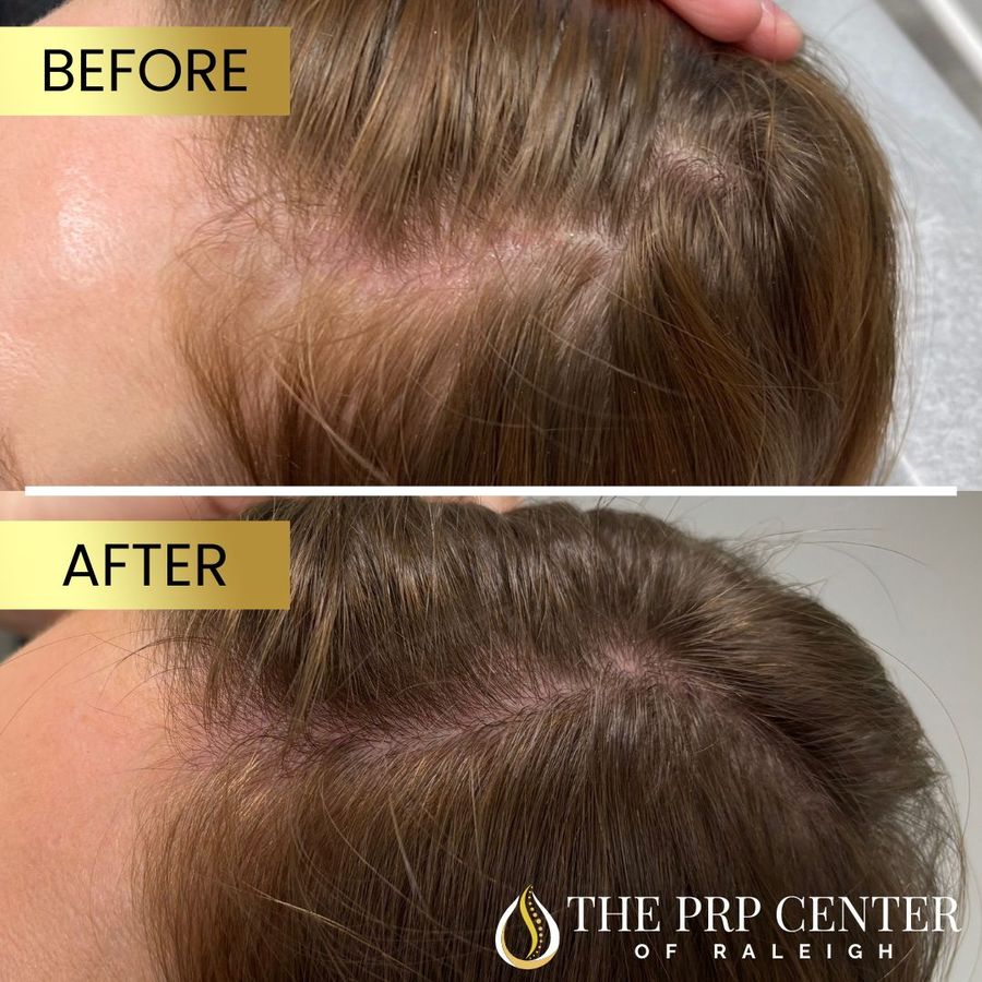 THE PRP CENTER: Nonsurgical Hair Loss Restoration - Raleigh Office photo 4
