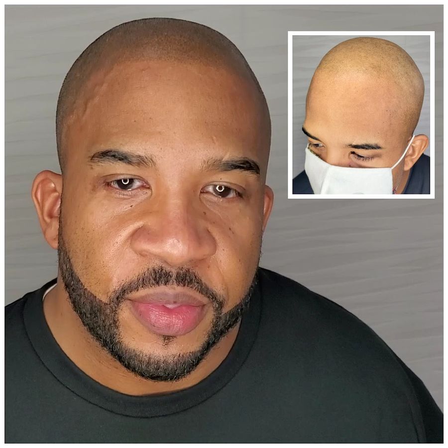 ATL Scalp Micro photo 2