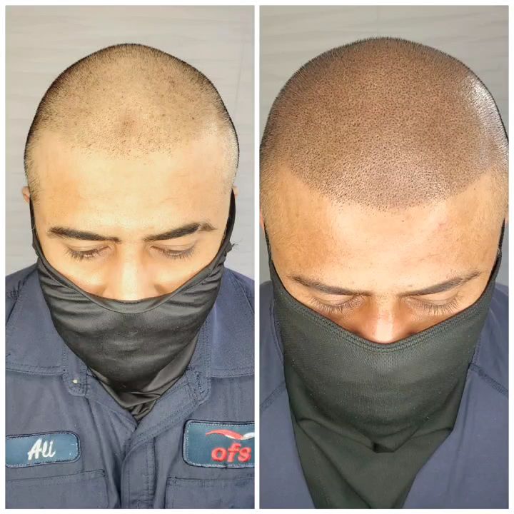 ATL Scalp Micro photo 3